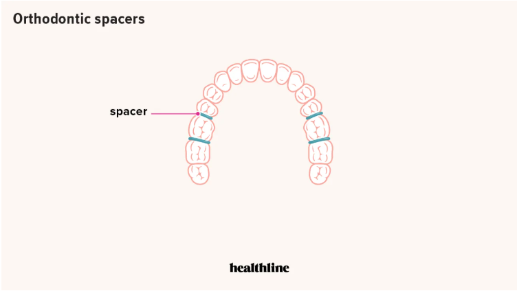 Orthodontic spacers, also known as orthodontic seperator, being shown in the mouth courtesy of Healthline